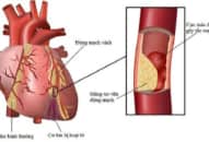 Bệnh động mạch vành: dấu hiệu, chẩn đoán, điều trị kịp thời
