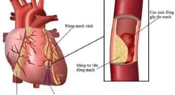 Bệnh động mạch vành: dấu hiệu, chẩn đoán, điều trị kịp thời