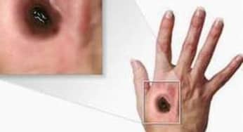 Bệnh than: phương thức lây truyền, điều trị bệnh