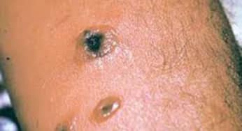 Bệnh than(Anthrax) – tổn thương da mủ do trực khuẩn Bacillus Anthracis