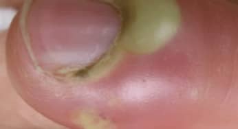 Bệnh nhiễm khuẩn: viêm cơ mủ, chín mé chớ xem thường