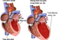 Nguyên nhân suy tim và kỹ thuật chẩn đoán bệnh suy tim