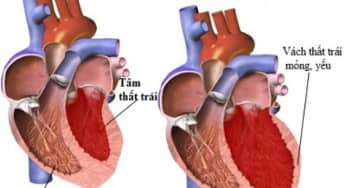 Nguyên nhân suy tim và kỹ thuật chẩn đoán bệnh suy tim