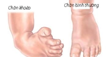 Hướng dẫn phục hồi chức năng cho trẻ bàn chân khoèo bẩm sinh theo BYT