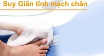 Bệnh suy tĩnh mạch chân: Triệu chứng và các phương pháp điều trị