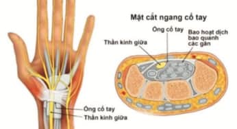 Phục hồi chức năng tổn thương thần kinh giữa theo Bộ Y tế