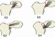 Phục hồi chức năng gãy cổ xương đùi theo BYT