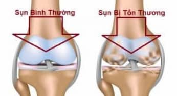 Phục hồi chức năng lao khớp theo BYT