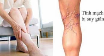 Phục hồi chức năng suy giãn tĩnh mạch chi dưới theo BYT