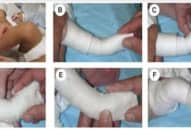 Kỹ thuật điều trị bàn chân khoèo bẩm sinh theo phương pháp Ponsetti