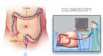 Nội soi đại tràng chẩn đoán và can thiệp được thực hiện như thế nào