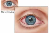 Đau mắt đỏ – Viêm kết mạc cấp