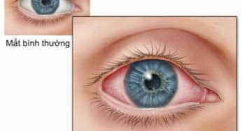Đau mắt đỏ – Viêm kết mạc cấp