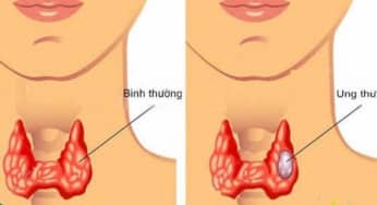Khi nào cần điều trị cắt bỏ u tuyến giáp