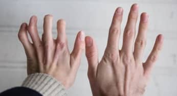 Những hiểu biết mới về tính tự miễn dịch trong bệnh viêm khớp dạng thấp