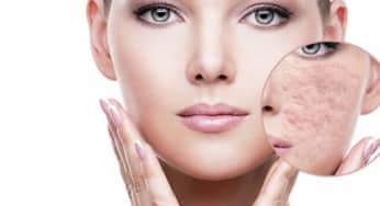 Mesotherapy Mix – Phương pháp điều trị sẹo sinh học