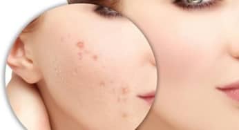UltraPulse: Công nghệ điều trị sẹo mới nhất