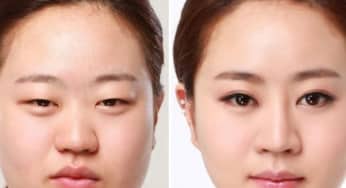 Cắt mí thẩm mỹ: Các câu hỏi thường gặp
