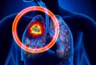 Dấu hiệu lạ ở bàn tay cảnh báo nguy cơ mắc bệnh ung thư phổi