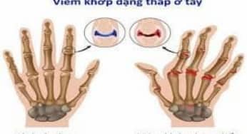 Mới: Tính tự miễn dịch trong bệnh viêm khớp dạng thấp