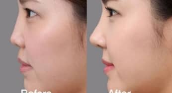 Tiêm filler những vấn đề nhất định bạn phải quan tâm