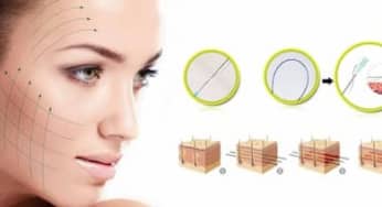 Có bao nhiêu loại chỉ căng da mặt hiện nay: Ưu điểm?