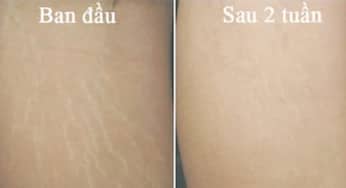 Công nghệ trị rạn da, trị sẹo Max Matrix mới