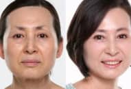 Phẫu thuật căng da mặt: Những yêu cầu trước và sau phẫu thuật