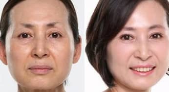 Phẫu thuật căng da mặt: Những yêu cầu trước và sau phẫu thuật