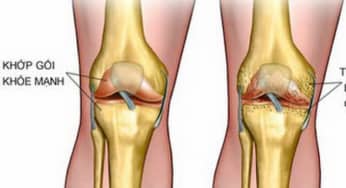 Thoái hóa khớp: Nguyên nhân, cấp độ, lộ trình điều trị