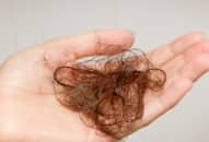 Bạn thuộc kiểu rụng tóc nào: Rụng tóc telogen?