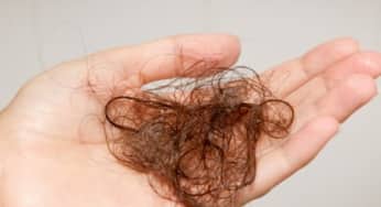 Bạn thuộc kiểu rụng tóc nào: Rụng tóc telogen?