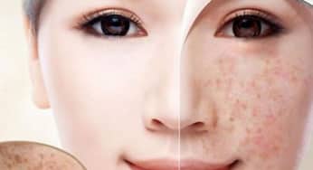 Cách điều trị các loại nám, tàn nhang
