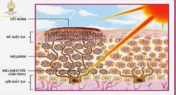 Hiểu về cơ chế tăng sinh melanin (nám) trên da để hạn chế chúng triệt để