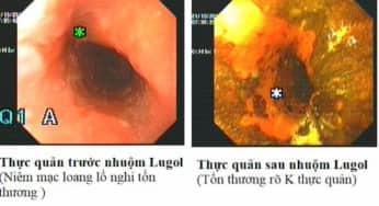 Nguyên tắc cơ bản nội soi, một số lưu ý hỗ trợ chẩn đoán ung thư sớm