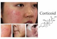 Tác dụng đáng sợ của Corticoid, cai nghiện Corticoid cho da