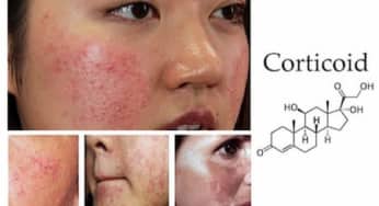 Tác dụng đáng sợ của Corticoid, cai nghiện Corticoid cho da