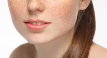 Tai biến khi sử dụng máy laser trong trị nám, xóa xăm