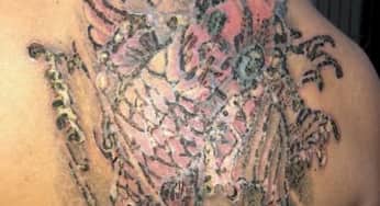 Trị nám, xóa xăm – những tai biến thường gặp