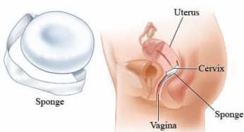 Miếng xốp ngừa thai: Ưu, nhược điểm và những khuyến cáo