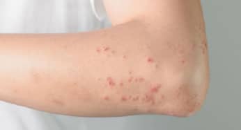 7 bệnh về da thường gặp ở bệnh nhân Celiac