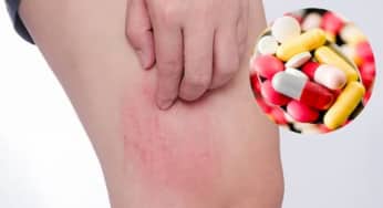 Dị ứng thuốc: biểu hiện, nguyên nhân, xử trí cấp cứu