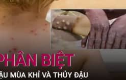 Phân biệt bệnh đậu mùa khỉ và thủy đậu theo BYT