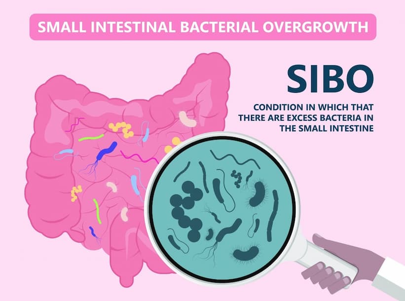 SIBO – Tăng sinh vi khuẩn ruột non: Hiểu đúng để chẩn đoán và điều trị hiệu quả