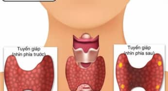 Viêm tuyến giáp thầm lặng