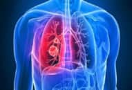 Áp xe phổi: Biến chứng nguy hiểm, cách phòng ngừa