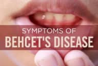 Bệnh Behcet’s, nguyên nhân, triệu chứng, chẩn đoán và điều trị