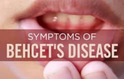 Bệnh Behcet’s, nguyên nhân, triệu chứng, chẩn đoán và điều trị