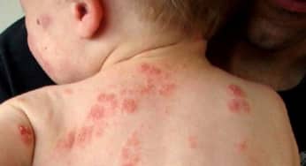Bệnh chốc lở ở trẻ em: triệu chứng, biến chứng, nguyên nhân, cách phòng ngừa
