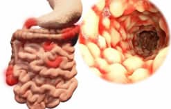 Bệnh Crohn nguyên nhân, phương pháp điều trị